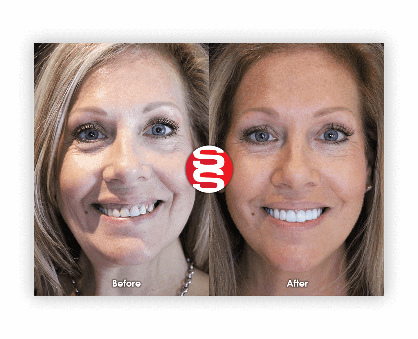 Women Smile Before After